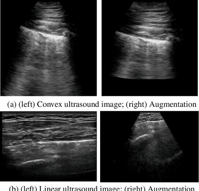 Figure 3 for COVID-Net US-X: Enhanced Deep Neural Network for Detection of COVID-19 Patient Cases from Convex Ultrasound Imaging Through Extended Linear-Convex Ultrasound Augmentation Learning
