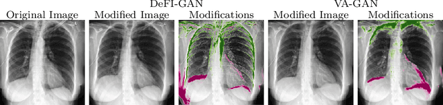 Figure 2 for Interpretation of Disease Evidence for Medical Images Using Adversarial Deformation Fields