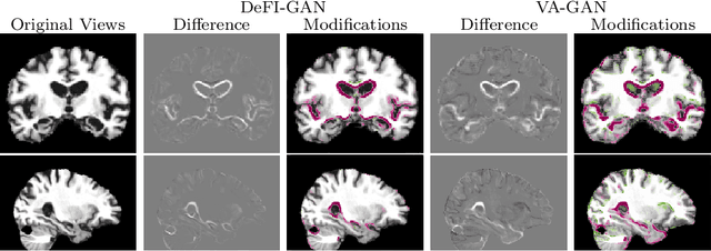 Figure 3 for Interpretation of Disease Evidence for Medical Images Using Adversarial Deformation Fields