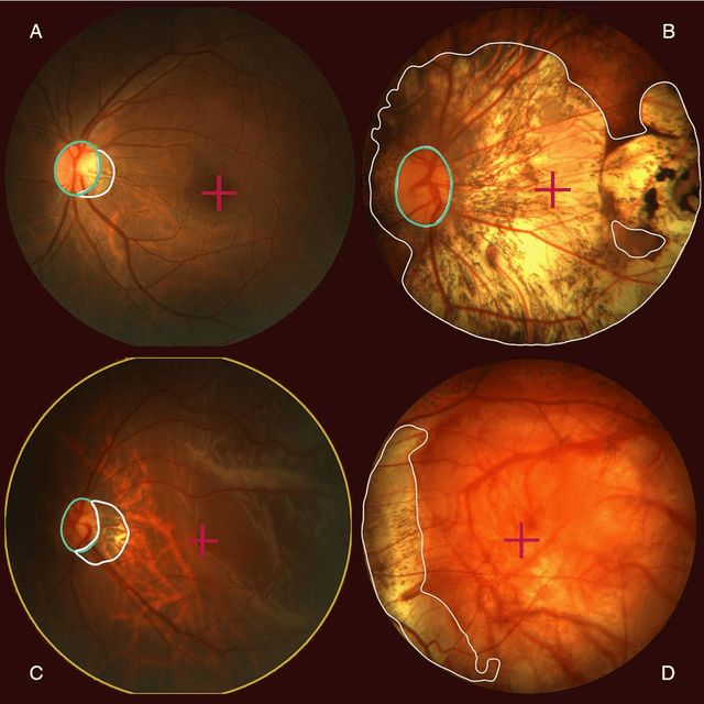 Figure 3 for Pathological myopia classification with simultaneous lesion segmentation using deep learning