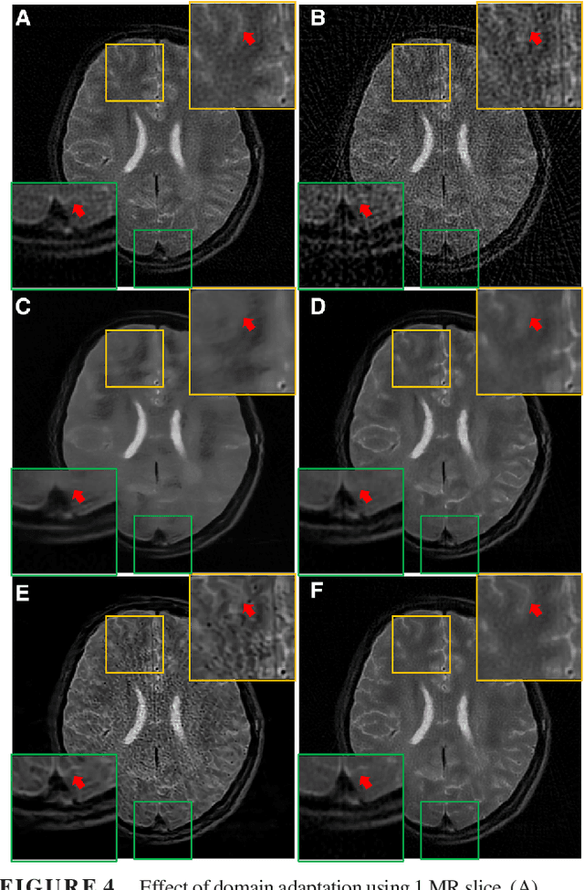 Figure 4 for Deep Learning with Domain Adaptation for Accelerated Projection-Reconstruction MR