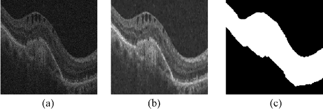 Figure 1 for Segmentation of retinal cysts from Optical Coherence Tomography volumes via selective enhancement