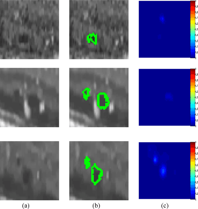 Figure 2 for Segmentation of retinal cysts from Optical Coherence Tomography volumes via selective enhancement