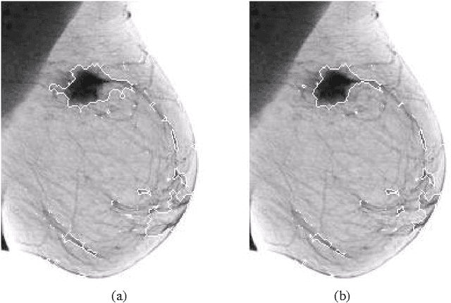 Figure 3 for Fractal-Based Detection of Microcalcification Clusters in Digital Mammograms