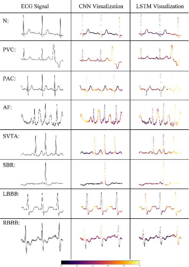 Figure 3 for Interpreting Deep Neural Networks for Single-Lead ECG Arrhythmia Classification