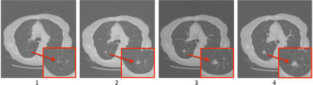 Figure 1 for Recurrent Convolutional Networks for Pulmonary Nodule Detection in CT Imaging
