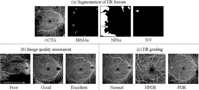 Figure 1 for Deep-OCTA: Ensemble Deep Learning Approaches for Diabetic Retinopathy Analysis on OCTA Images