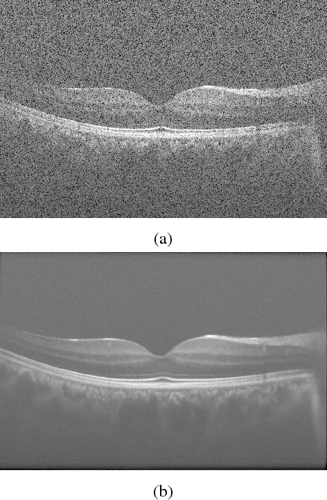 Figure 1 for Sparse And Low Rank Decomposition Based Batch Image Alignment for Speckle Reduction of retinal OCT Images
