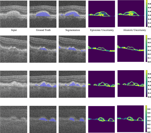 Figure 2 for Analyzing Epistemic and Aleatoric Uncertainty for Drusen Segmentation in Optical Coherence Tomography Images