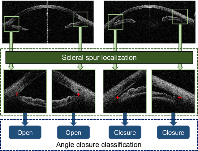 Figure 1 for AGE Challenge: Angle Closure Glaucoma Evaluation in Anterior Segment Optical Coherence Tomography