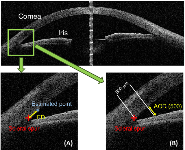 Figure 3 for AGE Challenge: Angle Closure Glaucoma Evaluation in Anterior Segment Optical Coherence Tomography