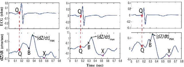 Figure 2 for ReBeatICG: Real-time Low-Complexity Beat-to-beat Impedance Cardiogram Delineation Algorithm