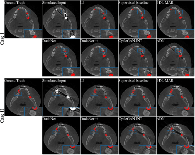 Figure 2 for Investigation of domain gap problem in several deep-learning-based CT metal artefact reduction methods