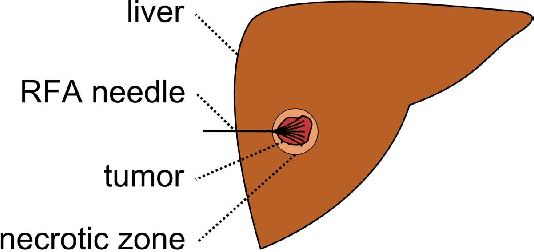 Figure 1 for Interactive Volumetry Of Liver Ablation Zones