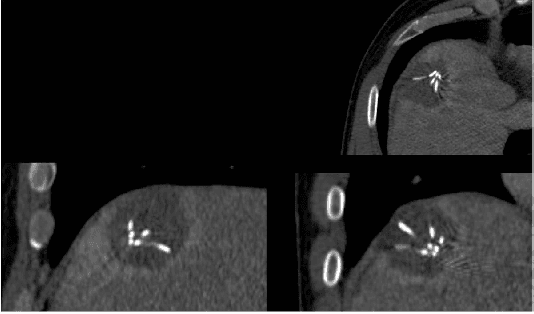 Figure 3 for Interactive Volumetry Of Liver Ablation Zones