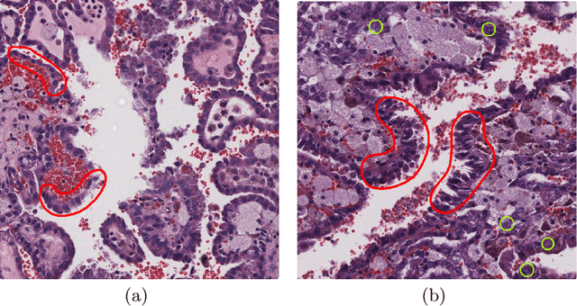 Figure 1 for Instance-based Vision Transformer for Subtyping of Papillary Renal Cell Carcinoma in Histopathological Image