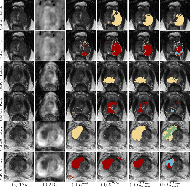 Figure 3 for Bridging the gap between prostate radiology and pathology through machine learning