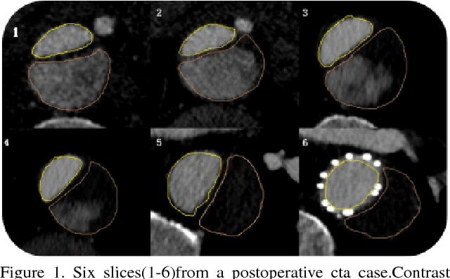 Figure 1 for Towards Personalized Management of Type B Aortic Dissection Using STENT: a STandard cta database with annotation of the ENtire aorta and True-false lumen