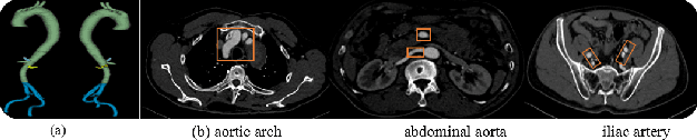 Figure 4 for Towards Personalized Management of Type B Aortic Dissection Using STENT: a STandard cta database with annotation of the ENtire aorta and True-false lumen