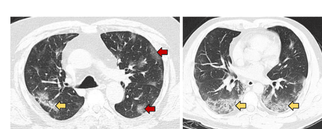 Figure 1 for CNN Filter Learning from Drawn Markers for the Detection of Suggestive Signs of COVID-19 in CT Images