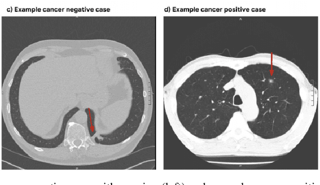 Figure 1 for 3D Neural Network for Lung Cancer Risk Prediction on CT Volumes