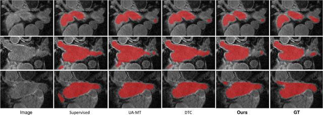 Figure 4 for Uncertainty-Guided Mutual Consistency Learning for Semi-Supervised Medical Image Segmentation