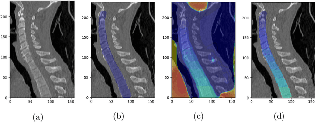 Figure 1 for Vertebrae Detection and Localization in CT with Two-Stage CNNs and Dense Annotations