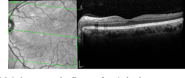 Figure 1 for Conditional GAN for Prediction of Glaucoma Progression with Macular Optical Coherence Tomography