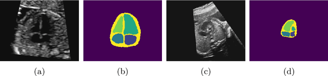 Figure 1 for Detecting Hypo-plastic Left Heart Syndrome in Fetal Ultrasound via Disease-specific Atlas Maps