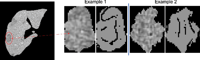 Figure 1 for Implanting Synthetic Lesions for Improving Liver Lesion Segmentation in CT Exams