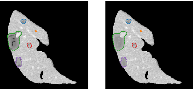 Figure 4 for Implanting Synthetic Lesions for Improving Liver Lesion Segmentation in CT Exams