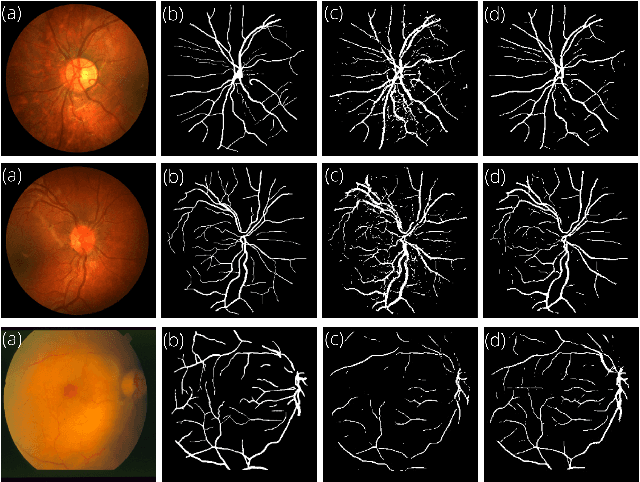 Figure 3 for Retinal Image Restoration and Vessel Segmentation using Modified Cycle-CBAM and CBAM-UNet