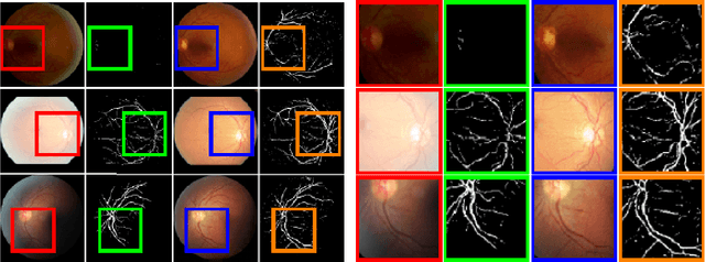 Figure 4 for Retinal Image Restoration and Vessel Segmentation using Modified Cycle-CBAM and CBAM-UNet