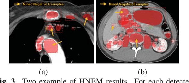 Figure 4 for ULDor: A Universal Lesion Detector for CT Scans with Pseudo Masks and Hard Negative Example Mining