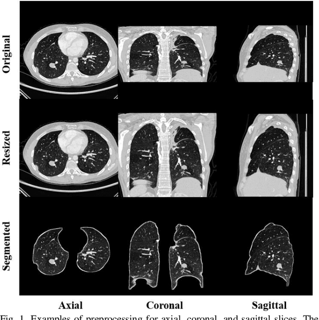 Figure 1 for Efficient convolutional neural networks for multi-planar lung nodule detection: improvement on small nodule identification