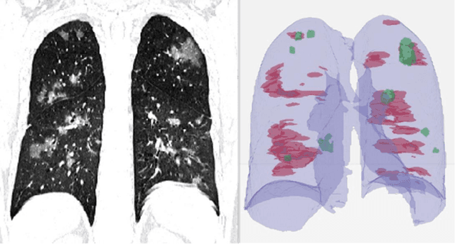 Figure 3 for Rapid AI Development Cycle for the Coronavirus (COVID-19) Pandemic: Initial Results for Automated Detection & Patient Monitoring using Deep Learning CT Image Analysis