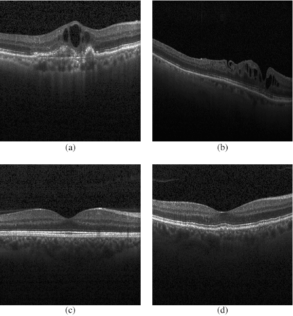 Figure 2 for Comparisonal study of Deep Learning approaches on Retinal OCT Image