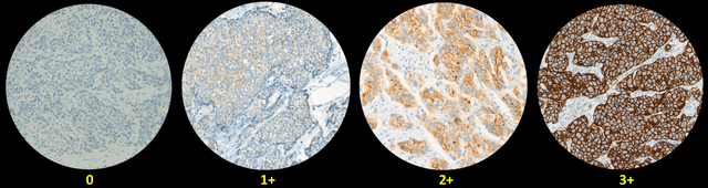 Figure 2 for Microscope Based HER2 Scoring System