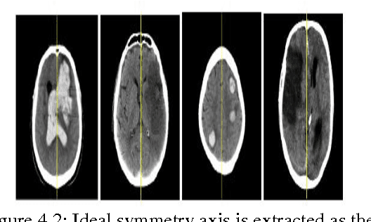 Figure 2 for Brain Tumor Detection Based on Bilateral Symmetry Information