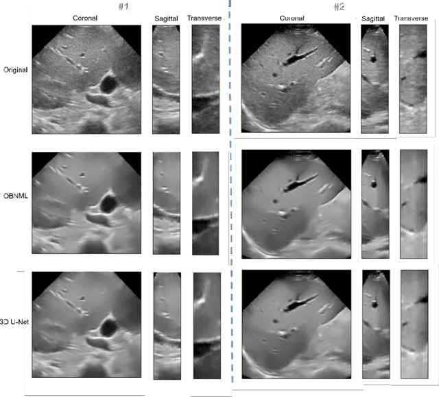 Figure 3 for 3D B-mode ultrasound speckle reduction using deep learning for 3D registration applications