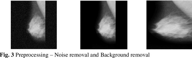 Figure 4 for Features based Mammogram Image Classification using Weighted Feature Support Vector Machine