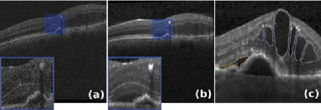 Figure 1 for Using CycleGANs for effectively reducing image variability across OCT devices and improving retinal fluid segmentation