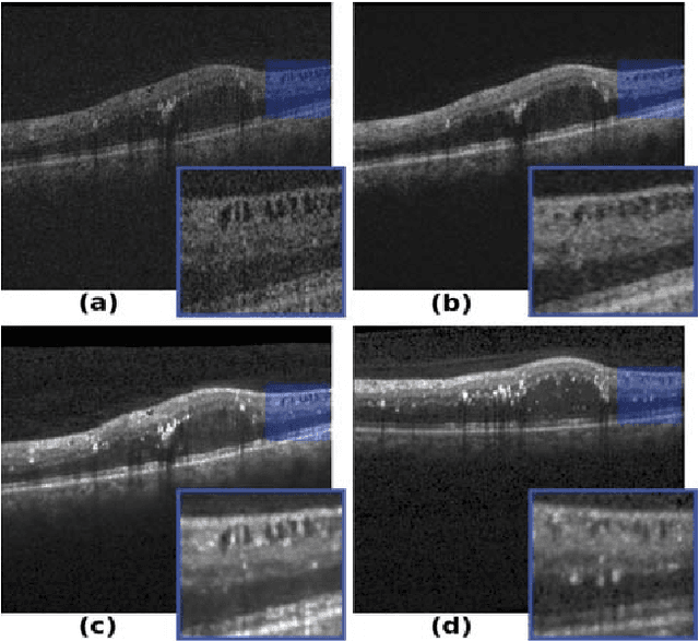 Figure 3 for Using CycleGANs for effectively reducing image variability across OCT devices and improving retinal fluid segmentation