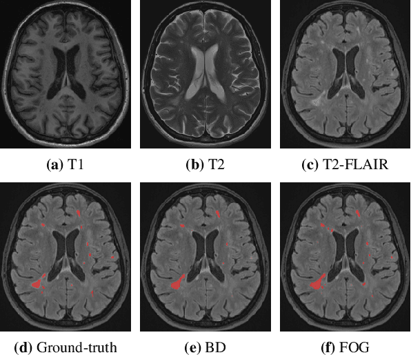 Figure 3 for Geometric Loss for Deep Multiple Sclerosis lesion Segmentation