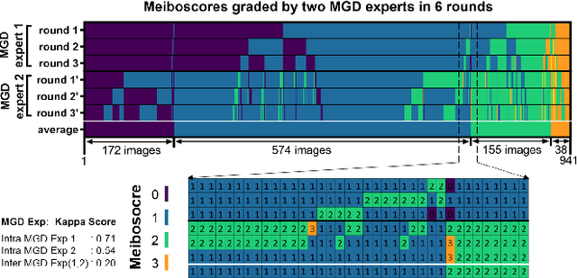 Figure 4 for AI-based automated Meibomian gland segmentation, classification and reflection correction in infrared Meibography