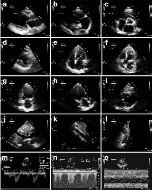 Figure 3 for Fast and accurate classification of echocardiograms using deep learning