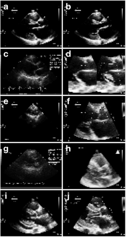 Figure 4 for Fast and accurate classification of echocardiograms using deep learning