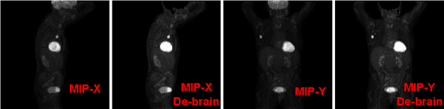 Figure 4 for AutoPET Challenge: Combining nn-Unet with Swin UNETR Augmented by Maximum Intensity Projection Classifier