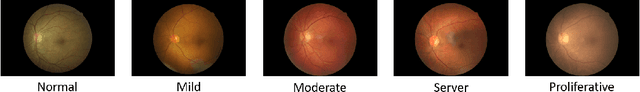 Figure 4 for BiRA-Net: Bilinear Attention Net for Diabetic Retinopathy Grading