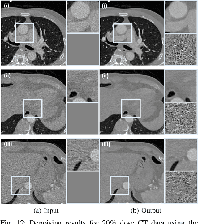 Figure 4 for Cycle-free CycleGAN using Invertible Generator for Unsupervised Low-Dose CT Denoising